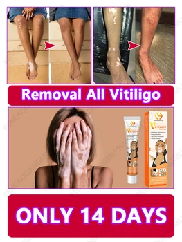 Vitiligo Cream Relief Отстраняване Отстраняване На Витилиго Най-Добрите Средства Срещу Витилиго Натурални Растителни Екстракти За Премахване На Витилиго