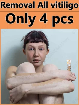 Vitiligo Cream Relief Отстраняване Отстраняване На Витилиго Най-Добрите Средства Срещу Витилиго Натурални Растителни Екстракти За Премахване На Витилиго 3